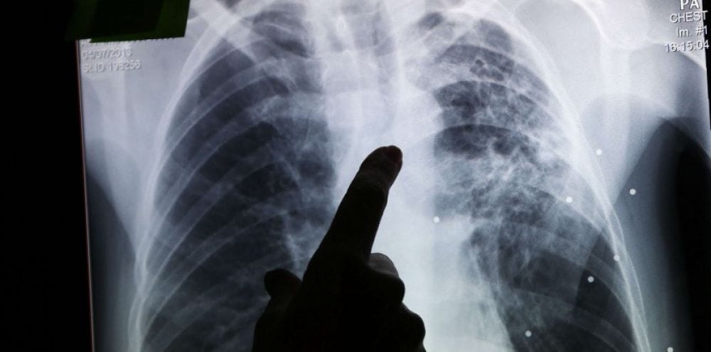 Lutte contre la tuberculose : le ministère de la Santé fixe ses objectifs 2 Tuberculose