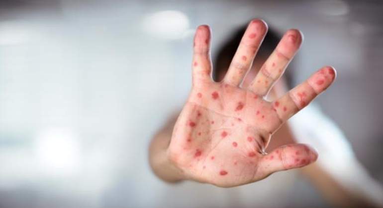 Afghanistan : la rougeole tue 156 personnes 2 le Maroc a enregistré 131 cas confirmés de rougeole en Juin, soit 2.753 confirmés au niveau national en 2024.