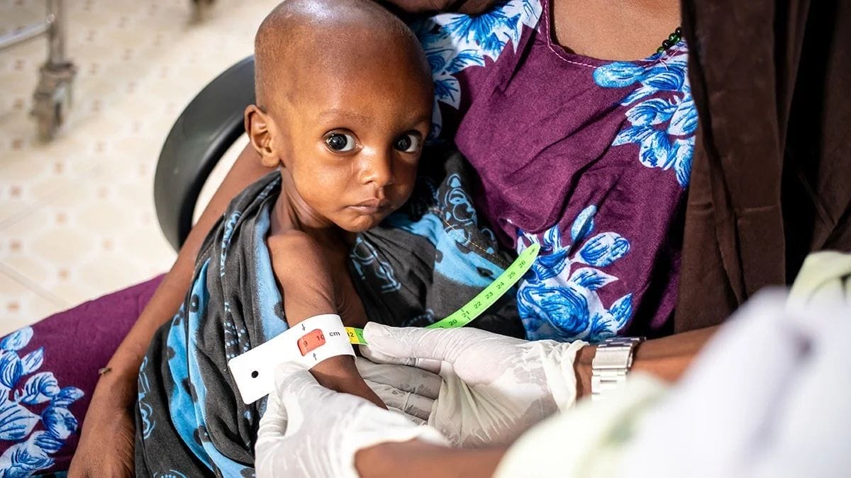 Somalie : 386.000 enfants souffrent de malnutrition, selon l’Unicef