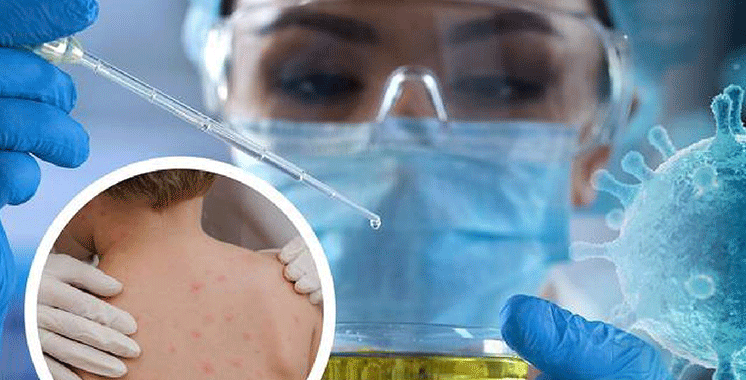 129 millions de dollars décaissé pour lutter contre le Mpox