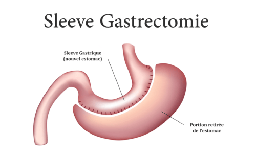 Obésité : qu’est-ce qu’une sleeve gastrique ? 1 Obésité : qu’est-ce qu’une sleeve gastrique ?