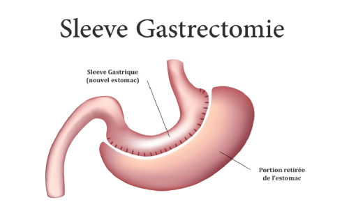 Obésité : qu’est-ce qu’une sleeve gastrique ?