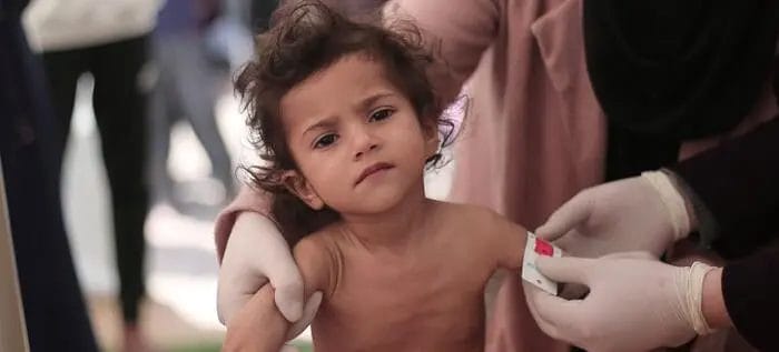 OMS : plus de 8.000 enfants en malnutrition aiguë à Gaza