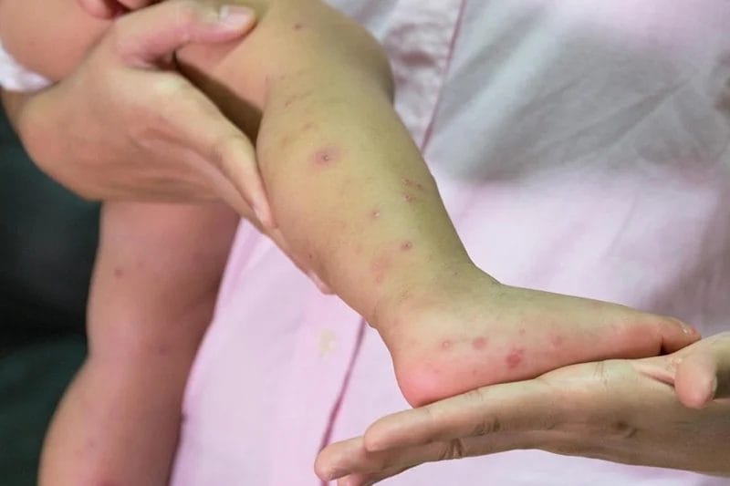 Tayeb Hamdi appelle à mener une enquête sur les facteurs qui ont mené à la réapparition de la rougeole